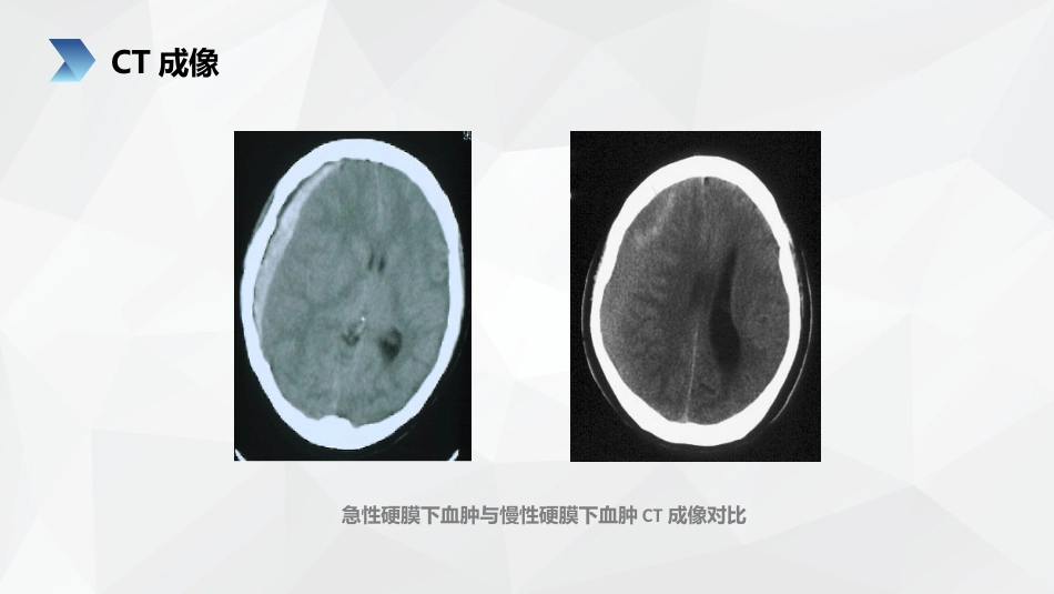 重症护理：亚急性硬膜下血肿护理查房_第14页
