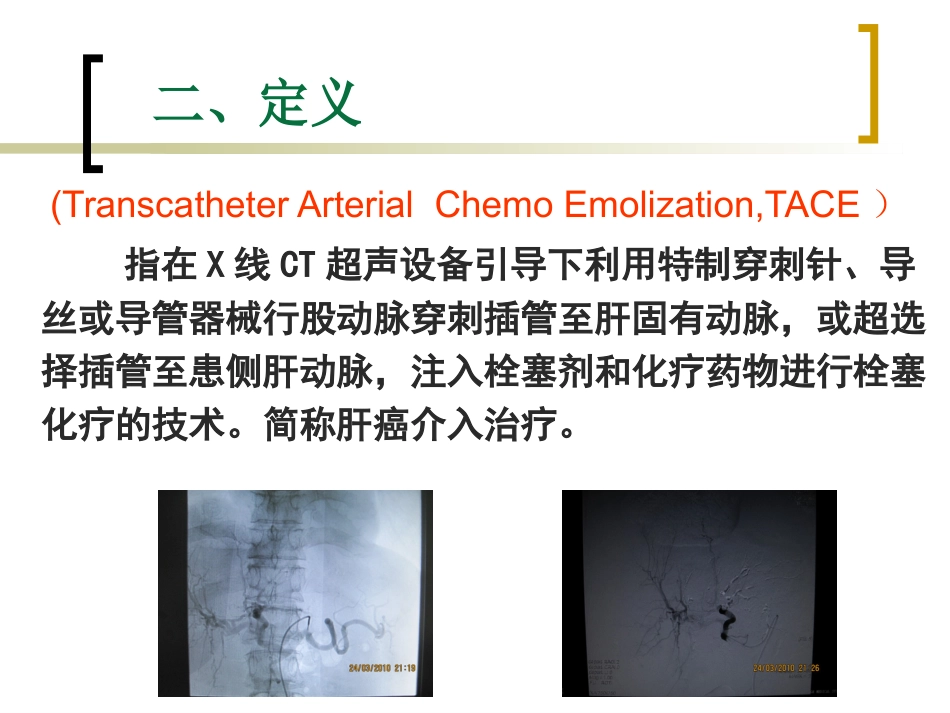 肝癌介入治疗的护理 ppt课件_第4页