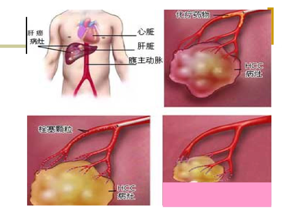 肝癌介入治疗的护理 ppt课件_第5页
