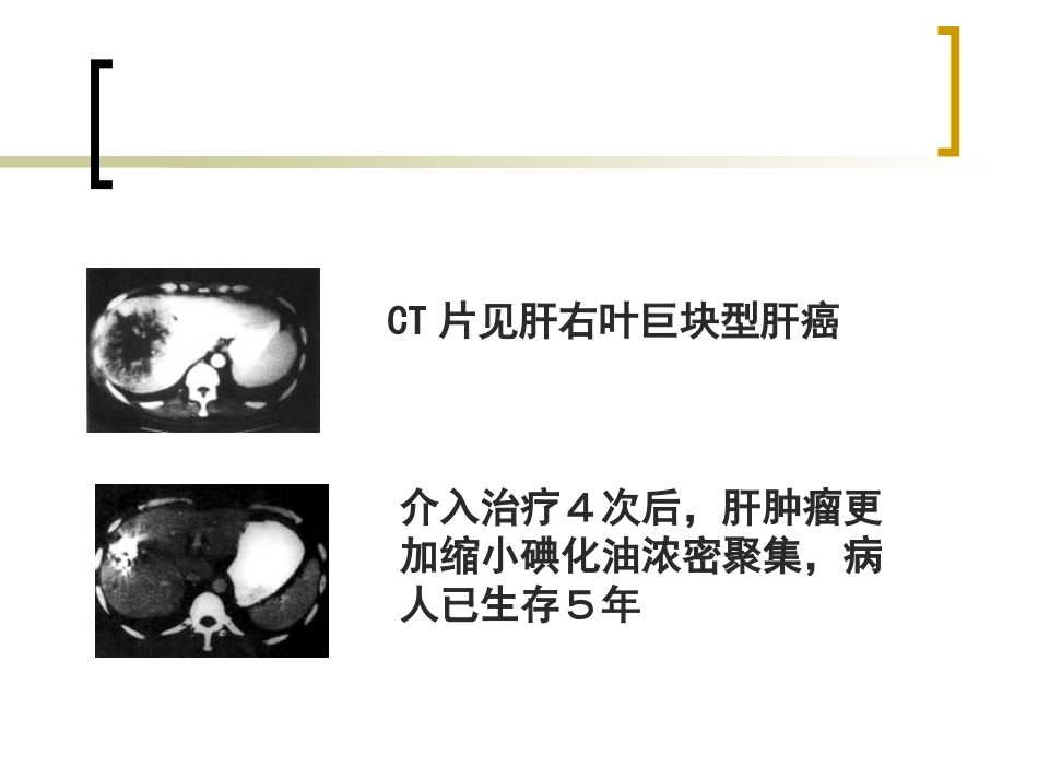 肝癌介入治疗的护理 ppt课件_第7页