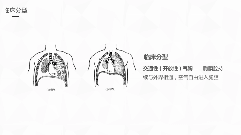 重症护理：结核性胸膜炎患者自发性气胸护理_第10页