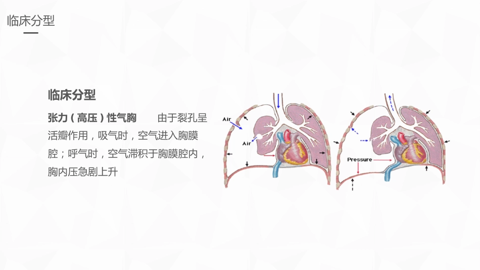 重症护理：结核性胸膜炎患者自发性气胸护理_第11页