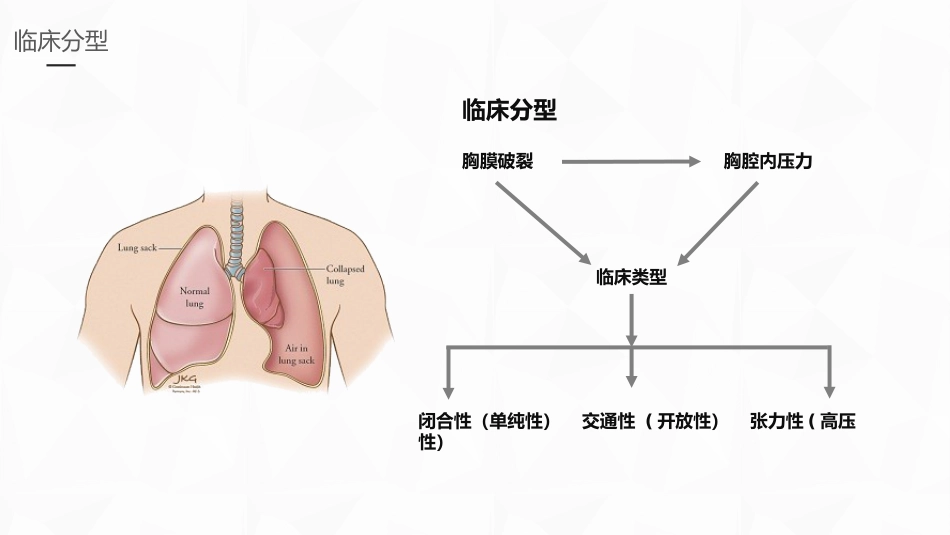 重症护理：结核性胸膜炎患者自发性气胸护理_第8页
