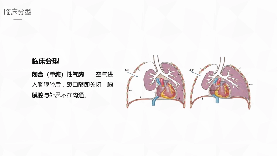 重症护理：结核性胸膜炎患者自发性气胸护理_第9页