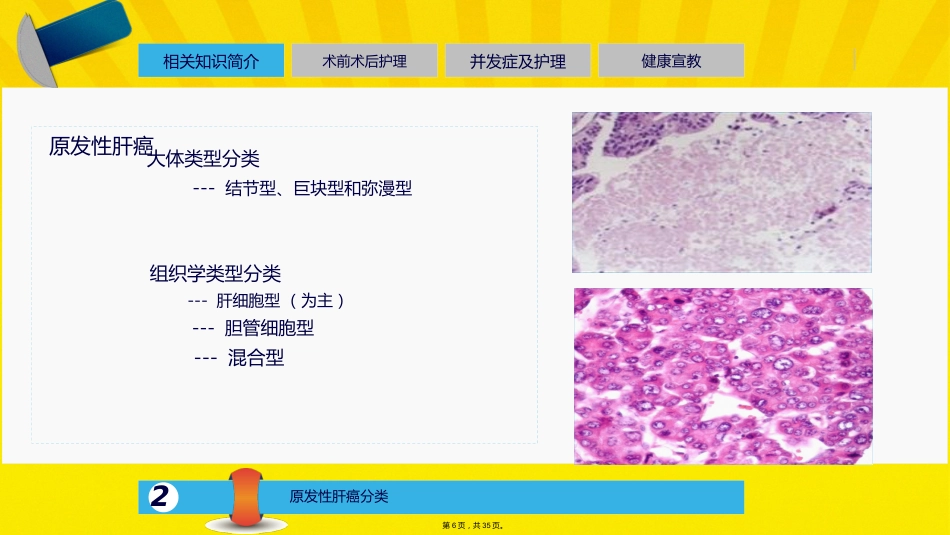 肝癌介入的治疗与护理_第5页