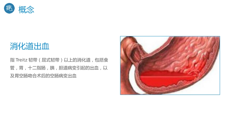 重症护理：消化道出血护理_第4页