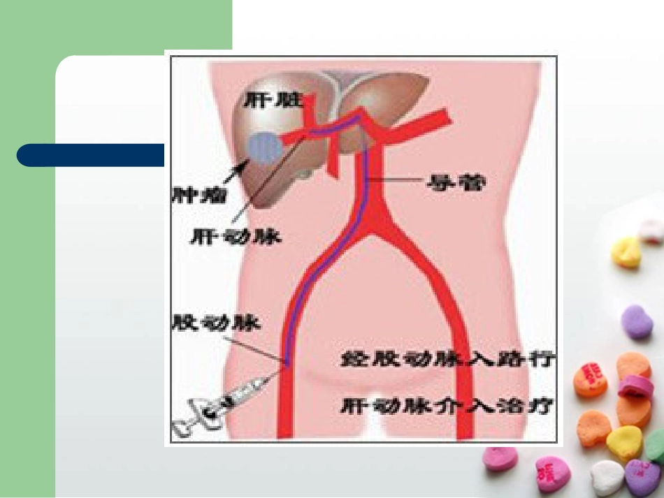 肝癌介入治疗的护理查房ppt课件_第5页