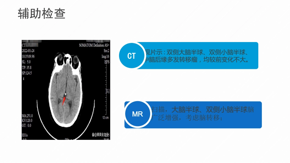 一例乳腺癌伴脑转移患者的护理个案_第9页