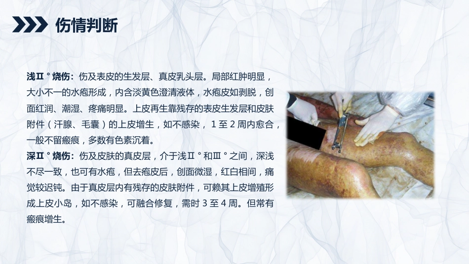 重症护理：烧伤患者护理查房_第7页