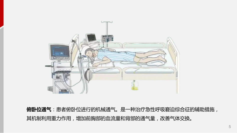 成人机械通气患者俯卧位护理_第5页