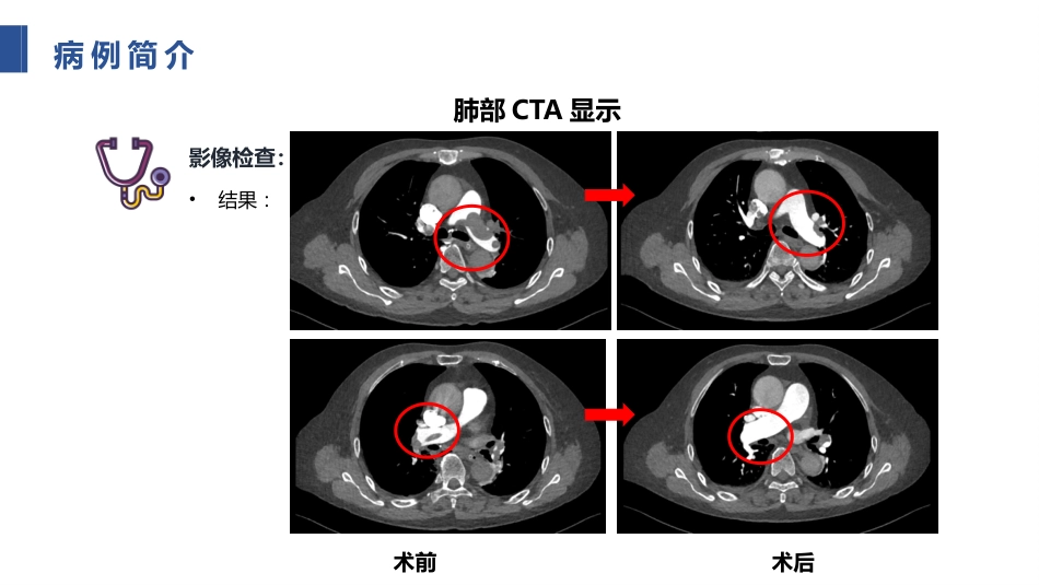 一例肺栓塞患者的护理个案_第13页