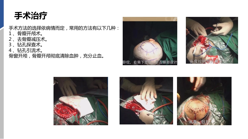 硬膜外血肿护理查房_第14页