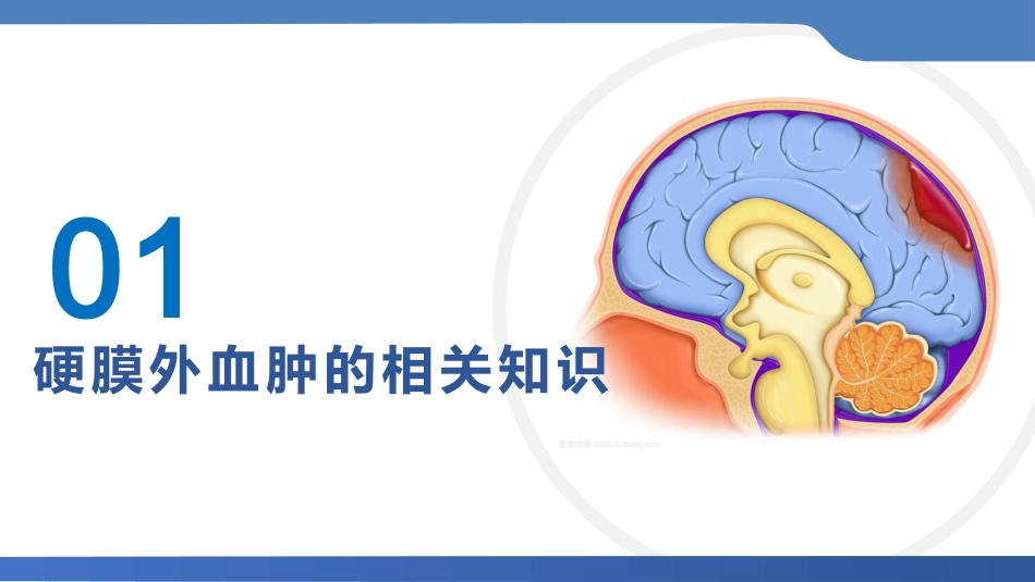 硬膜外血肿护理查房_第3页