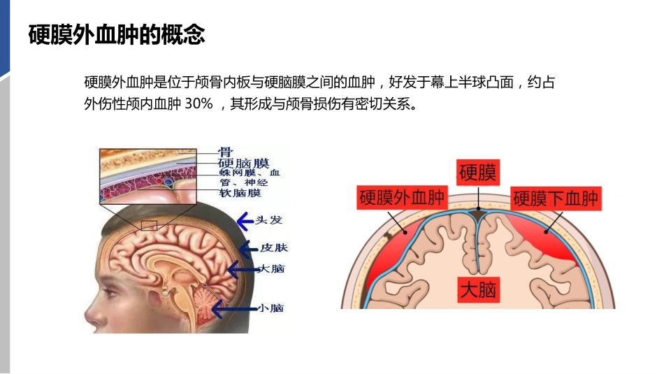硬膜外血肿护理查房_第6页