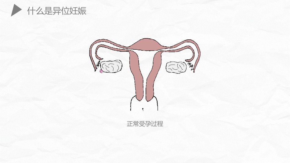 妇产护理：异位妊娠护理_第11页