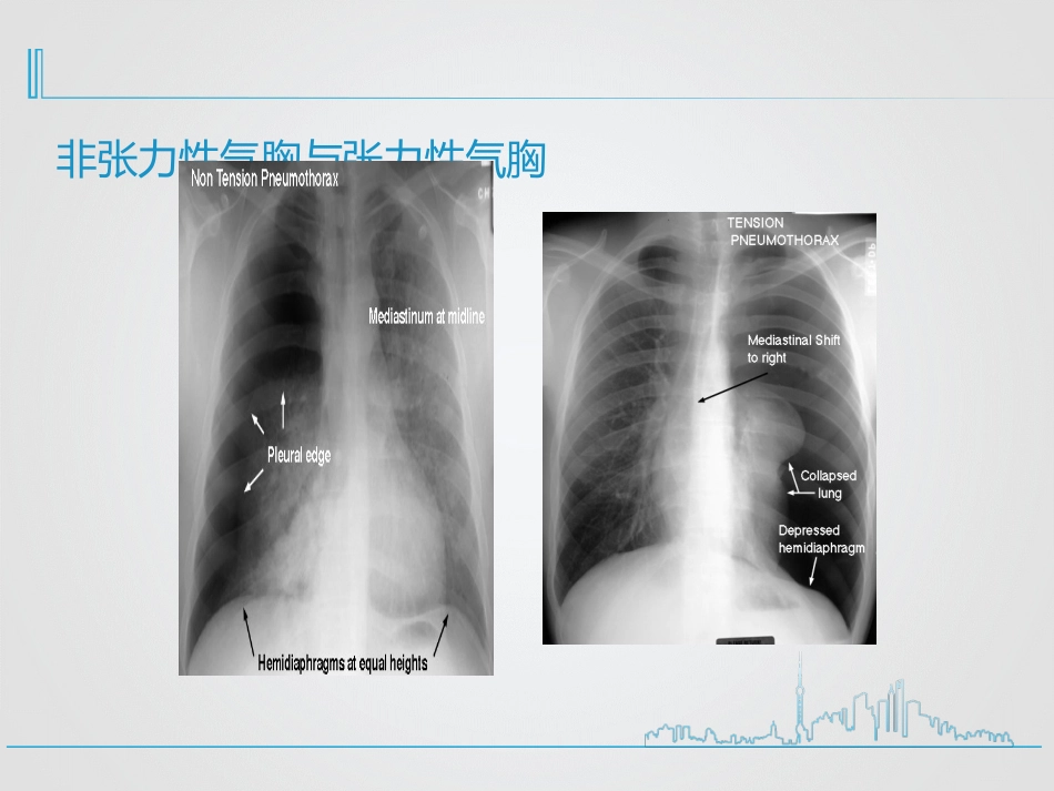 创伤性血气胸的急救与护理_第13页