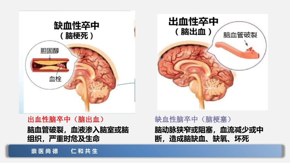 脑卒中的急救和护理_第9页