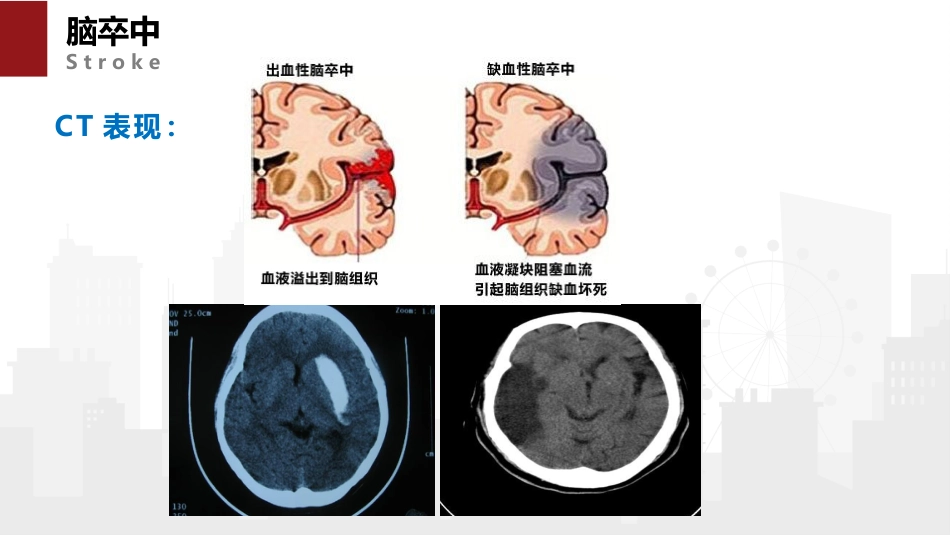 脑卒中病人的急救与护理_第5页