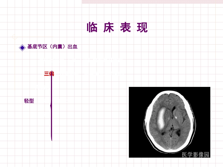 脑出血急救护理_第15页