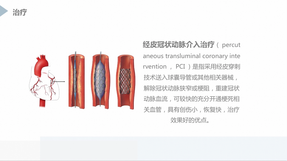 急性心肌梗死患者pci术后护理_第7页