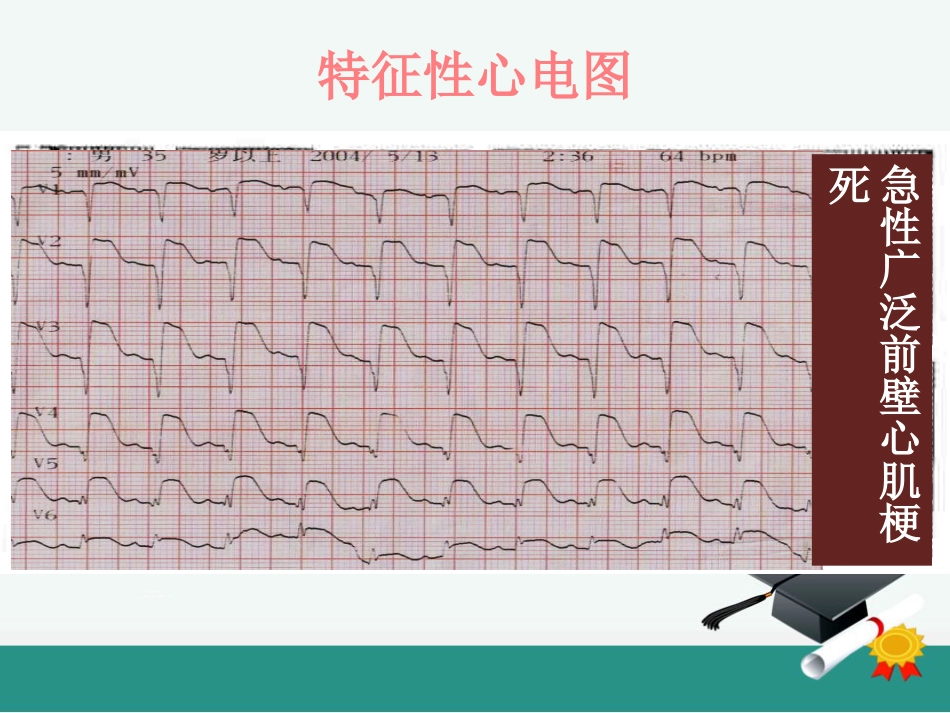 急性心肌梗死的溶栓护理查房_第10页
