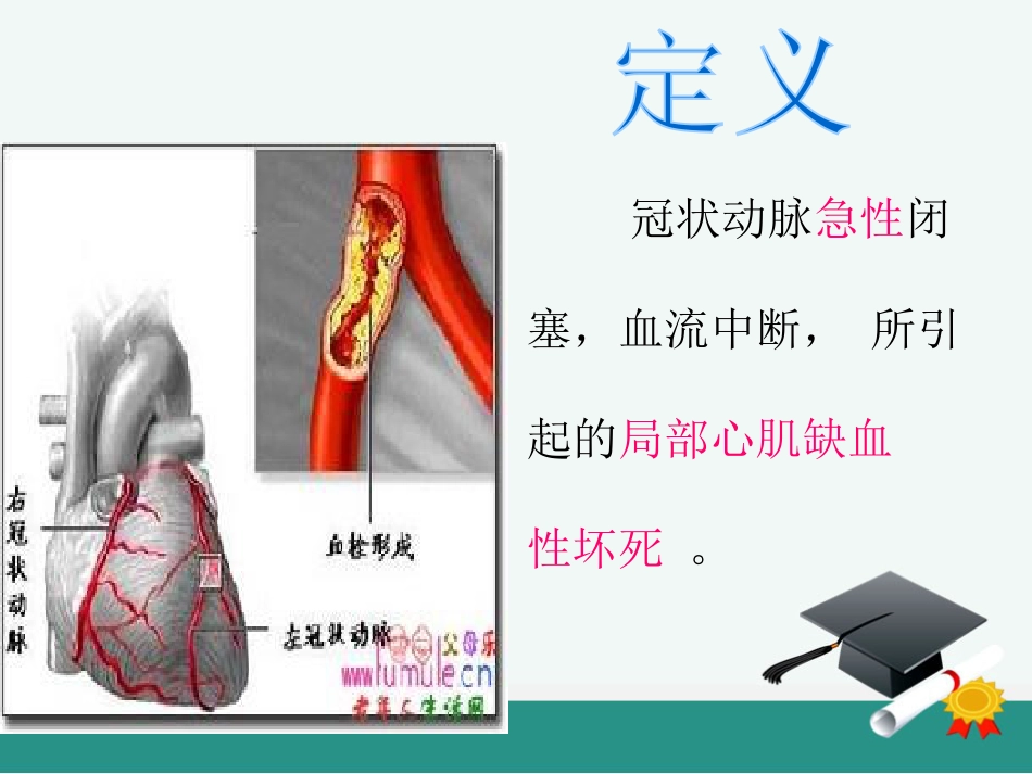 急性心肌梗死的溶栓护理查房_第4页