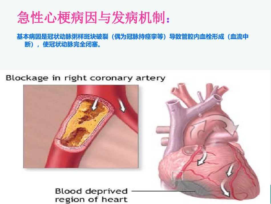 急性心肌梗死的溶栓护理查房_第5页