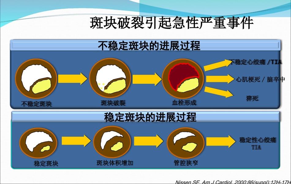 急性心肌梗死的抢救与护理_第3页
