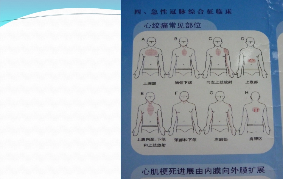 急性心肌梗死的抢救与护理_第7页