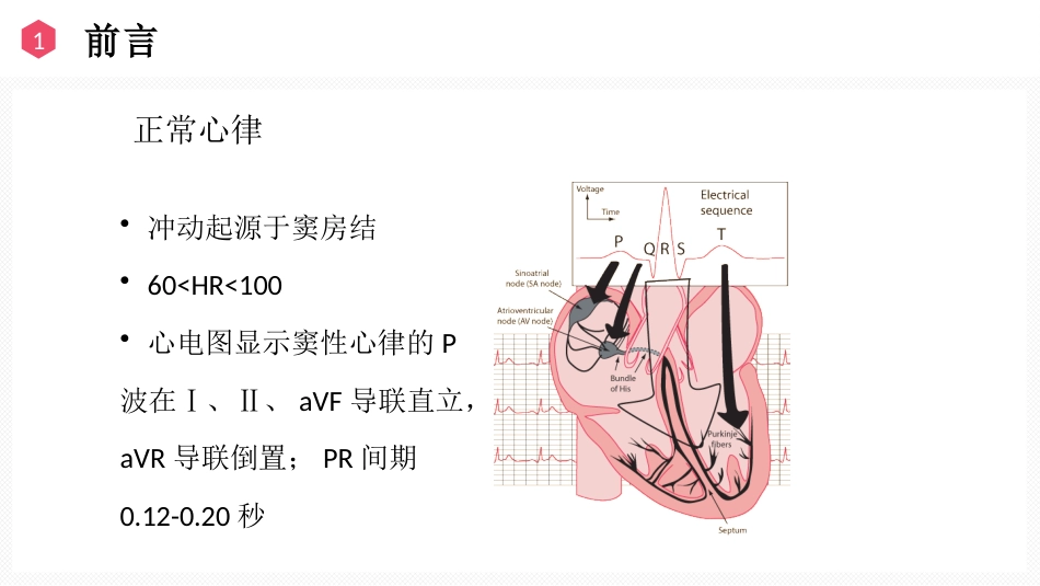 恶性心律失常的识别与护理_第3页