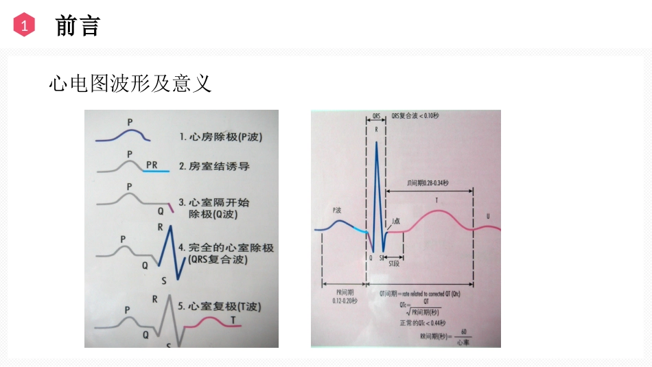 恶性心律失常的识别与护理_第4页