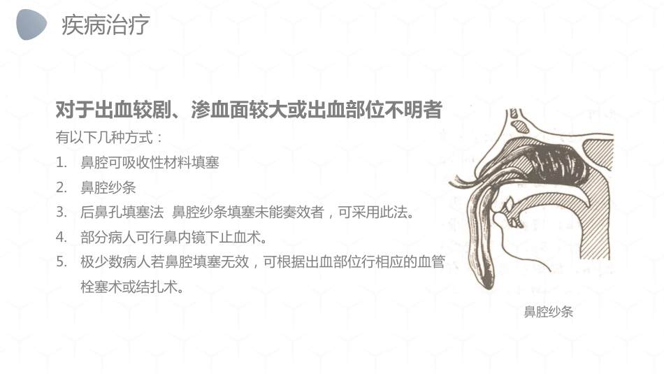 急诊护理：鼻出血护理_第15页
