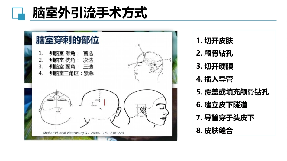 脑室外引流管的护理完整版_第8页