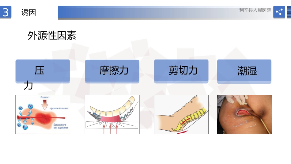 压力性损伤预防护理实操指南_第13页
