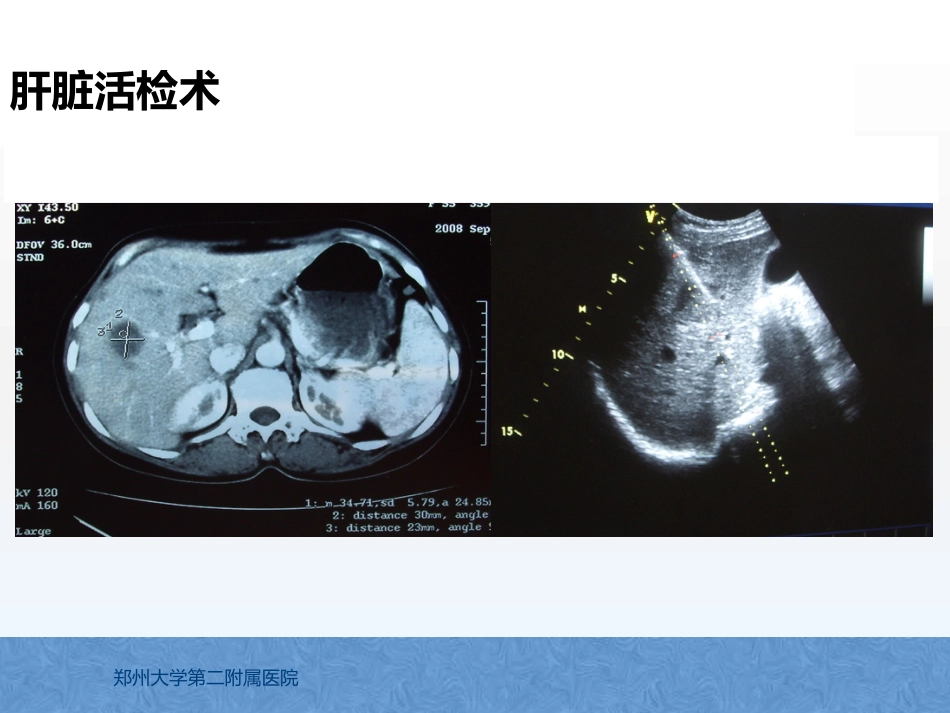 原发性肝癌诊疗指南解读_第12页