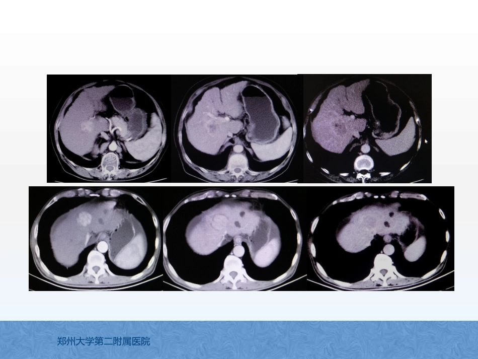 原发性肝癌诊疗指南解读_第6页