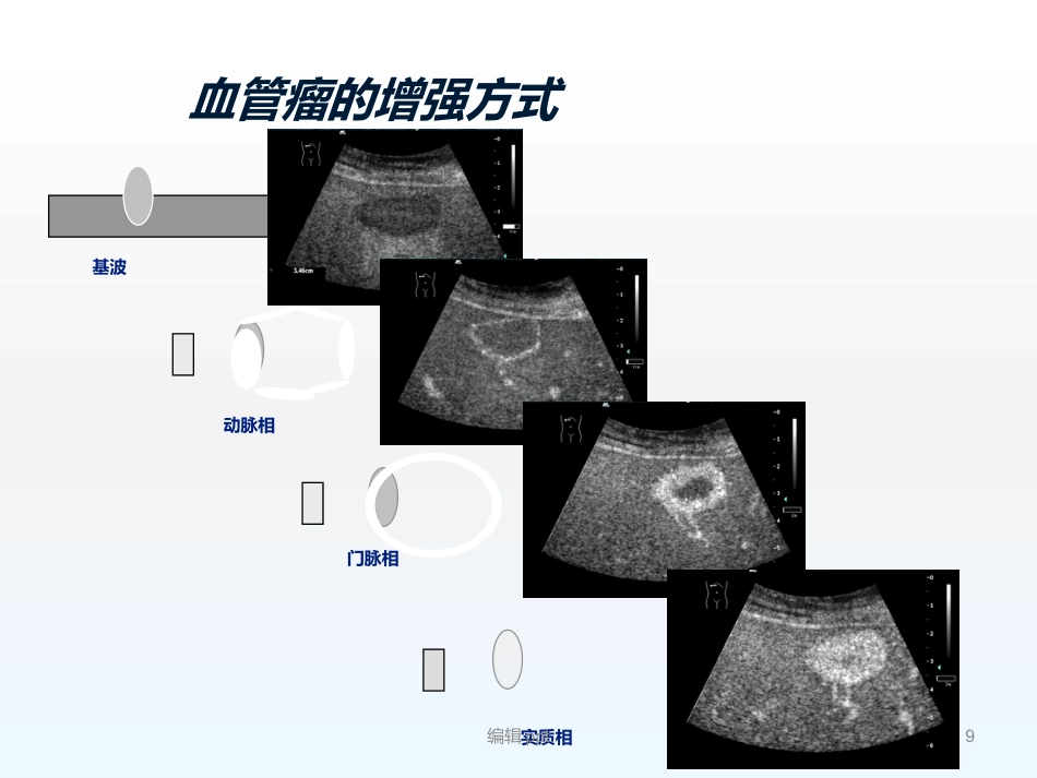 原发性肝癌诊疗指南解读_第9页