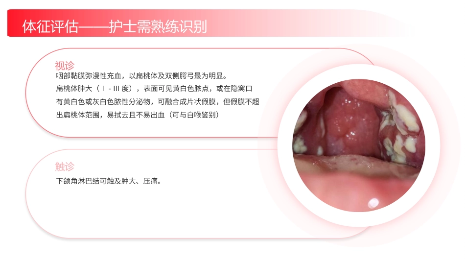 化脓性扁桃体炎护理查房带参考文献_第14页