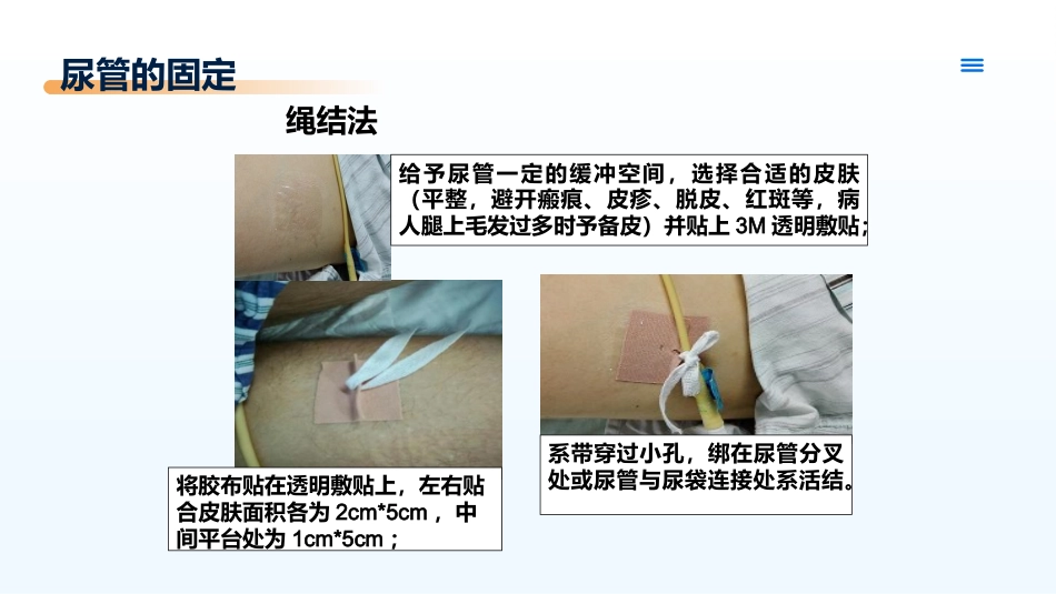 临床各类引流管的固定及规范管理_第15页