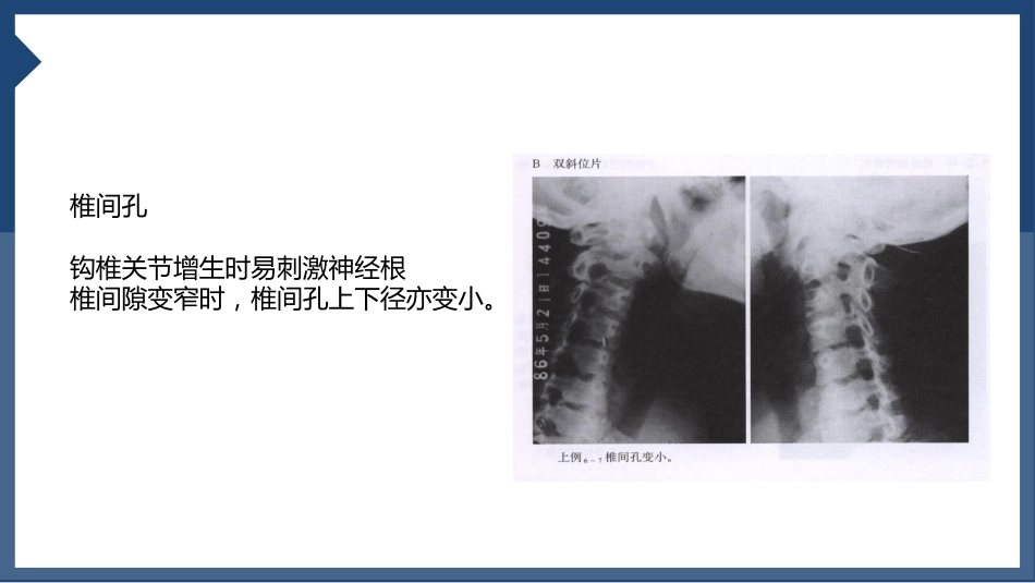 颈椎病_第13页