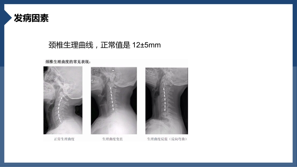 颈椎病_第6页