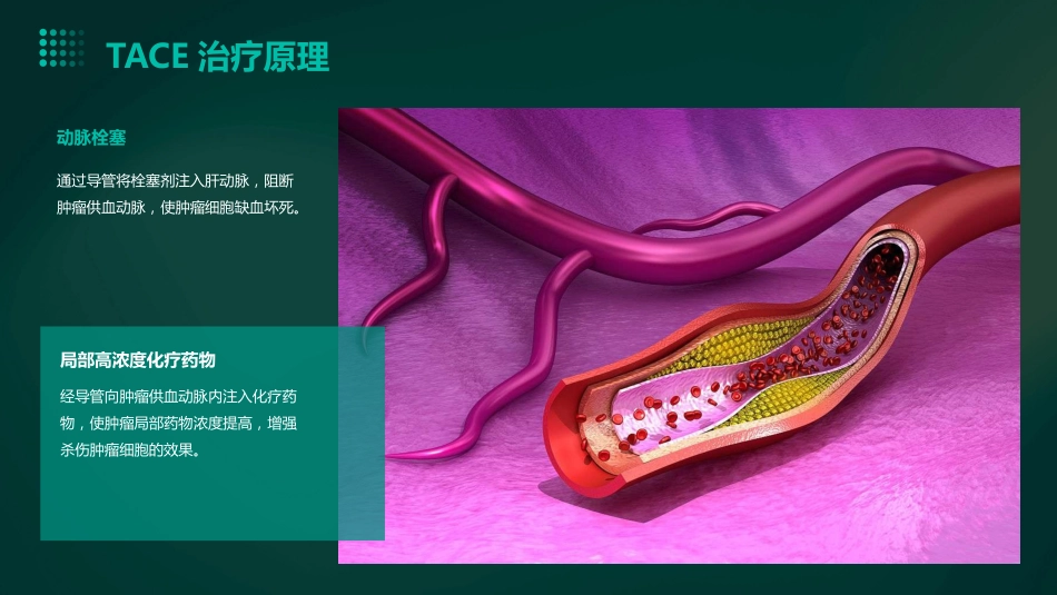 中国肝细胞癌经动脉化疗栓塞(TACE)治疗临床实践指南解读PPT课件_第12页