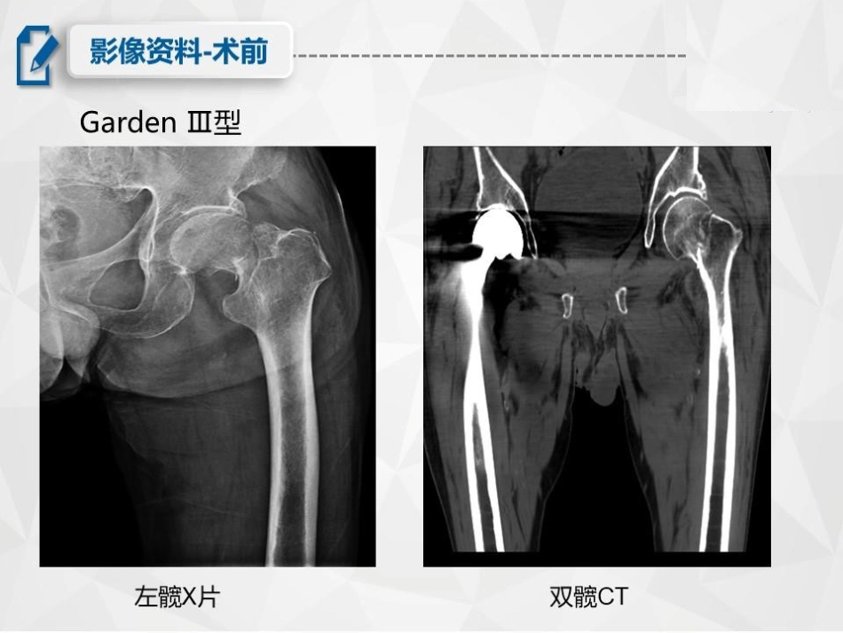 骨折尿毒症患者的围手术期护理_第4页