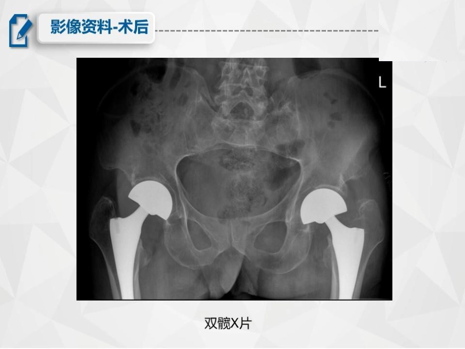 骨折尿毒症患者的围手术期护理_第5页