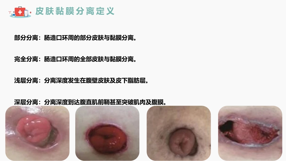 成人肠造口皮肤黏膜分离护理指南解读_第4页