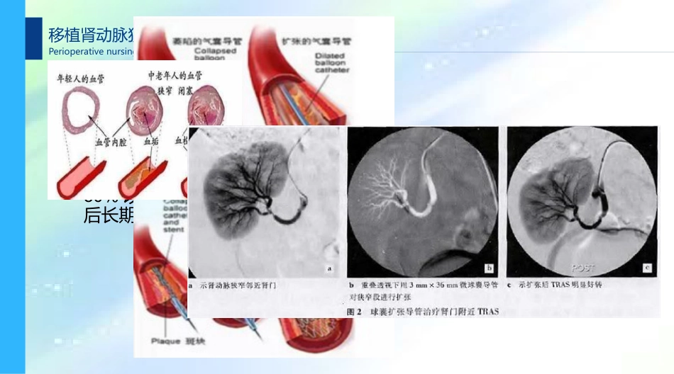 肾移植术后肾动脉狭窄及围手术期的护理_第10页