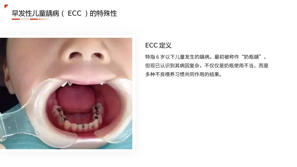 儿童龋病护理查房带参考文献_第5页