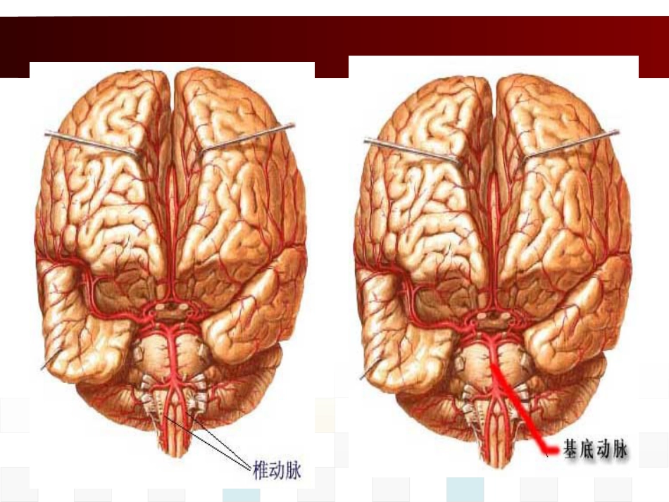 脑血管疾病病人的护理_第9页