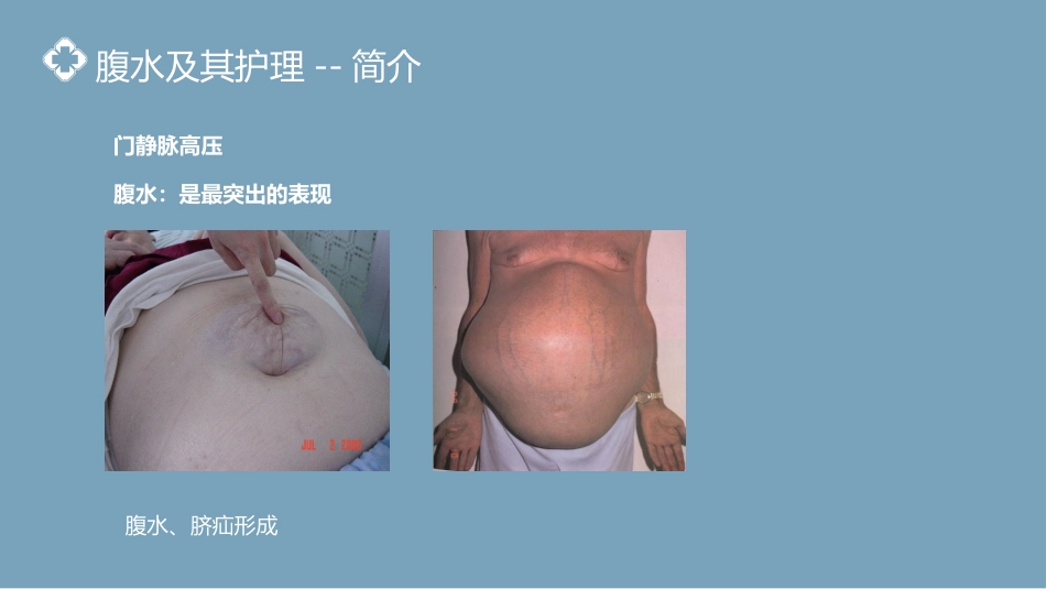 内科护理：肝硬化腹水病人的护理PPT模板_第12页