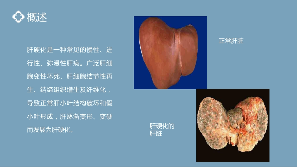 内科护理：肝硬化腹水病人的护理PPT模板_第4页
